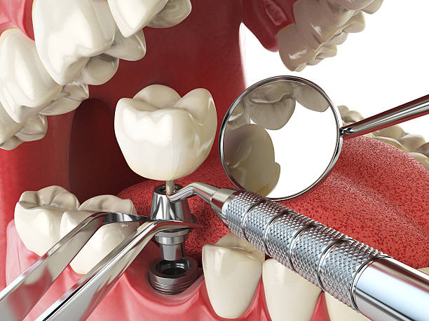 Best Dental Abscess Treatment in Oakland, OR